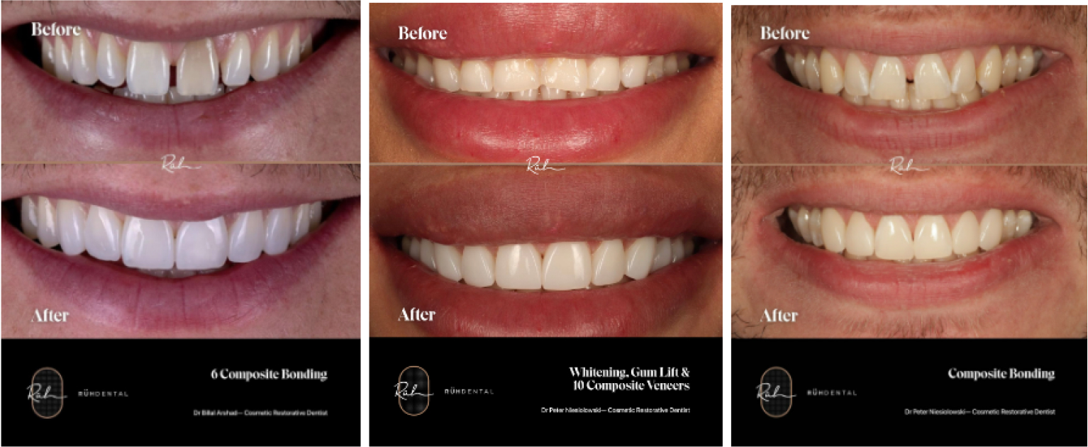 Composite Bonding Before-After