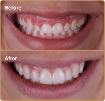 composite-before-after-2