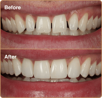 composite-before-after-3