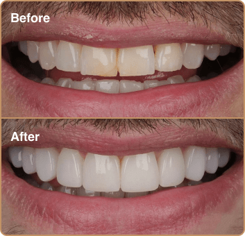 composite-before-after-4 (1)