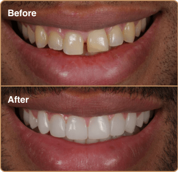 composite-before-after-5