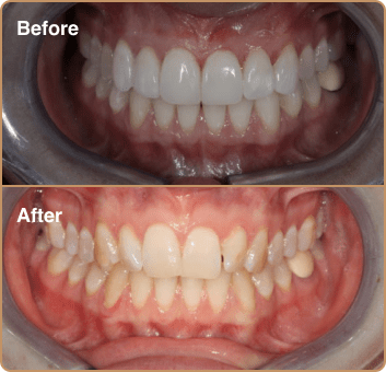 composite-before-after-6