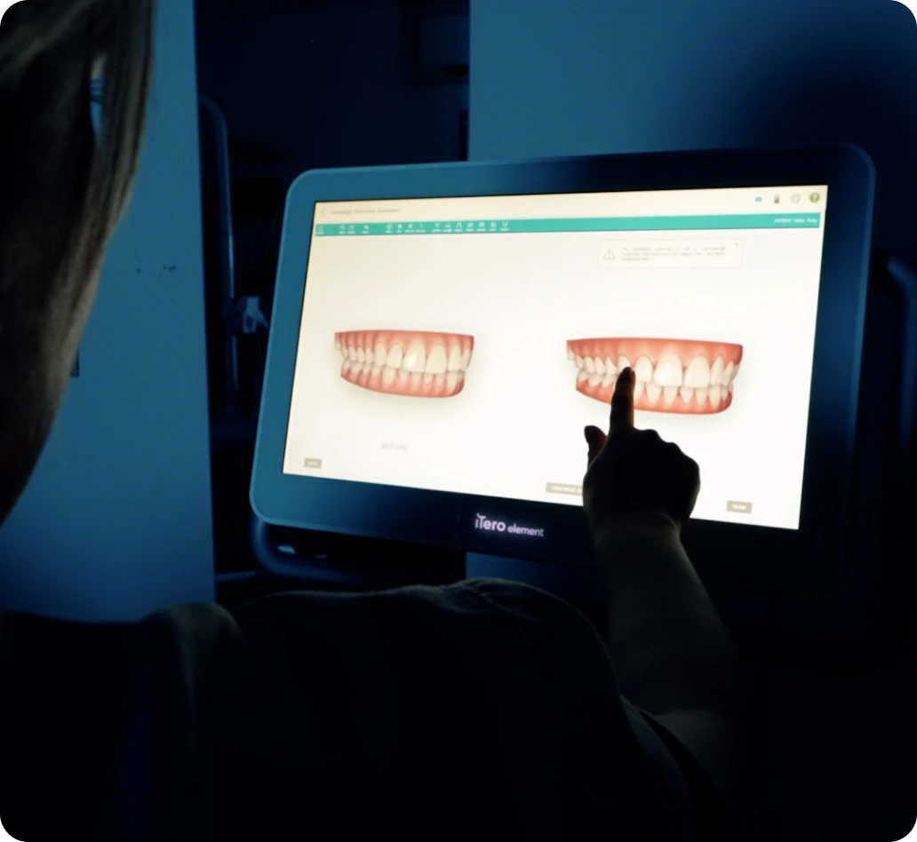 3D-Consultation Invisalign simulation