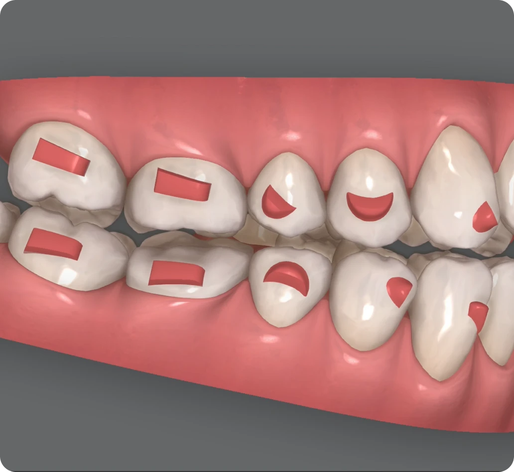 Invisalign Clincheck Invisalign Clincheck