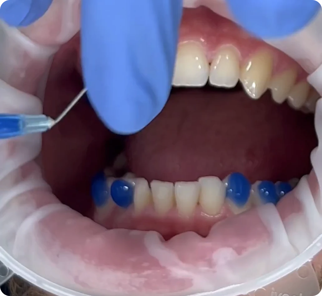 Invisalign Fitting Invisalign Fitting