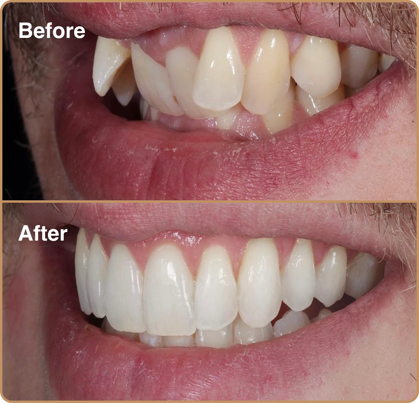 Invisalign-one Invisalign London before and after – correcting crooked front teeth