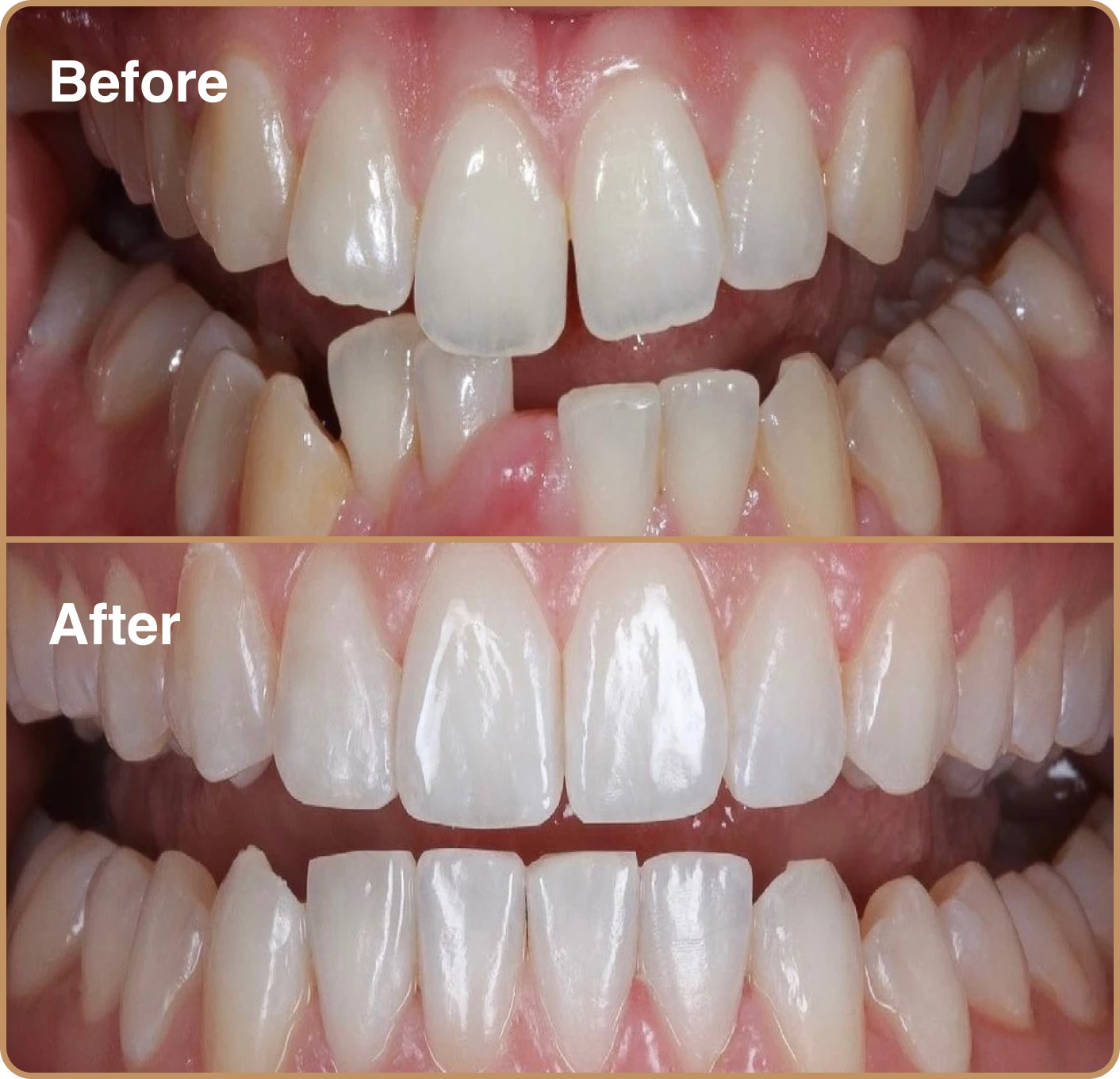 Invisalign-three Invisalign before and after London – straightening crooked lower teeth
