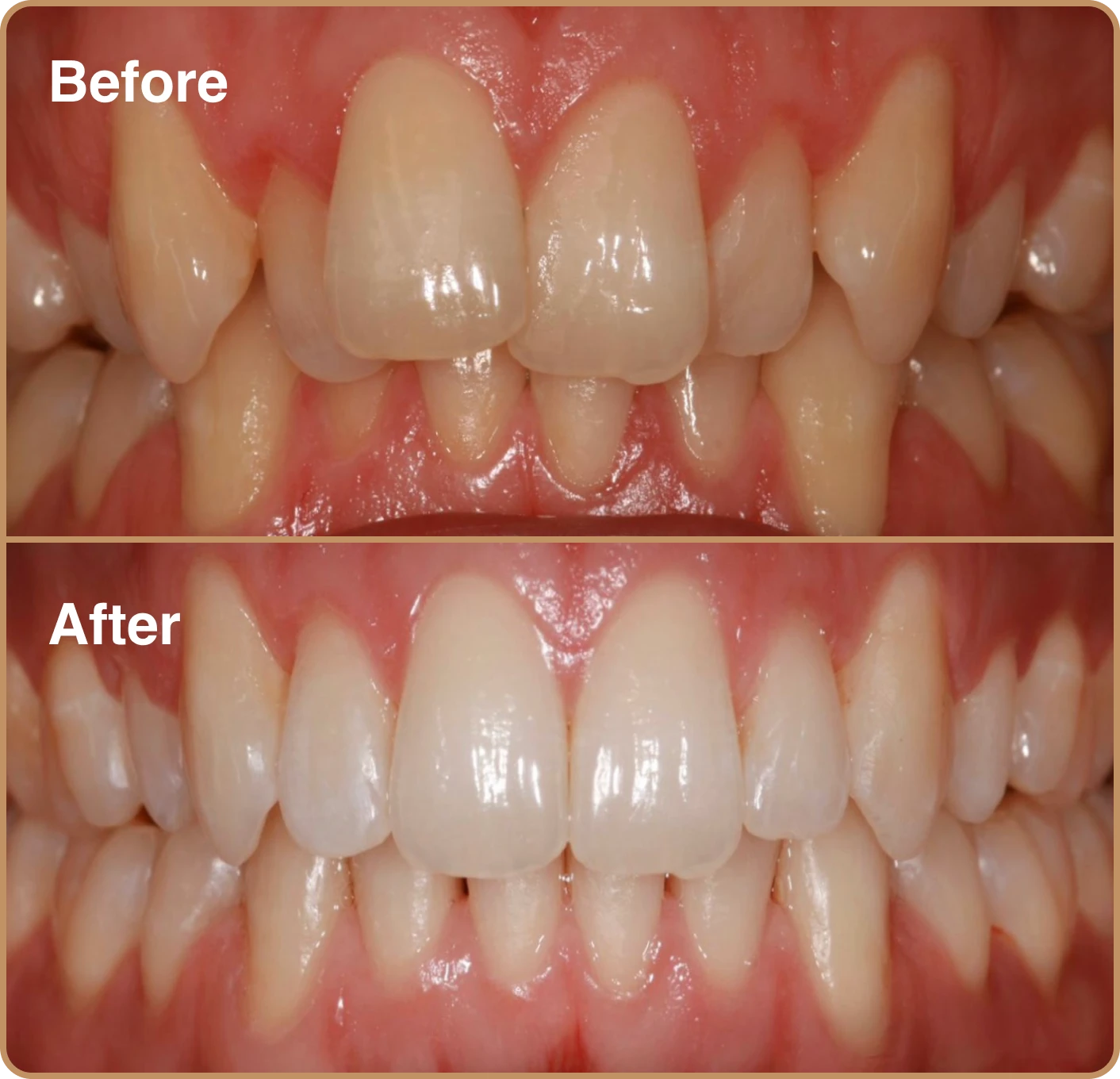 Invisalign-two Misaligned teeth Invisalign before and after
