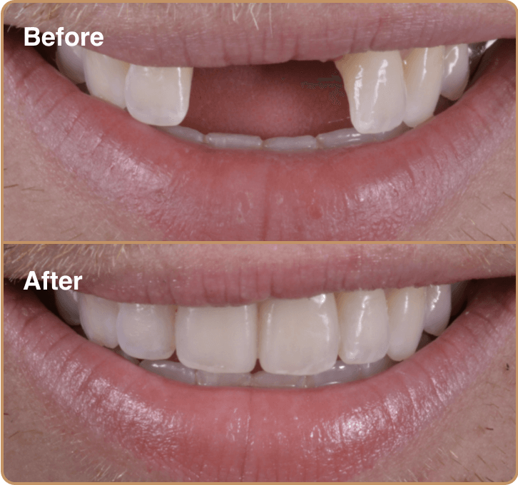 Implant-Before-and-after-1