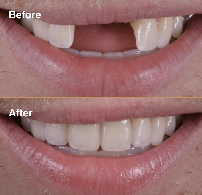 dental-implant-before-after-1