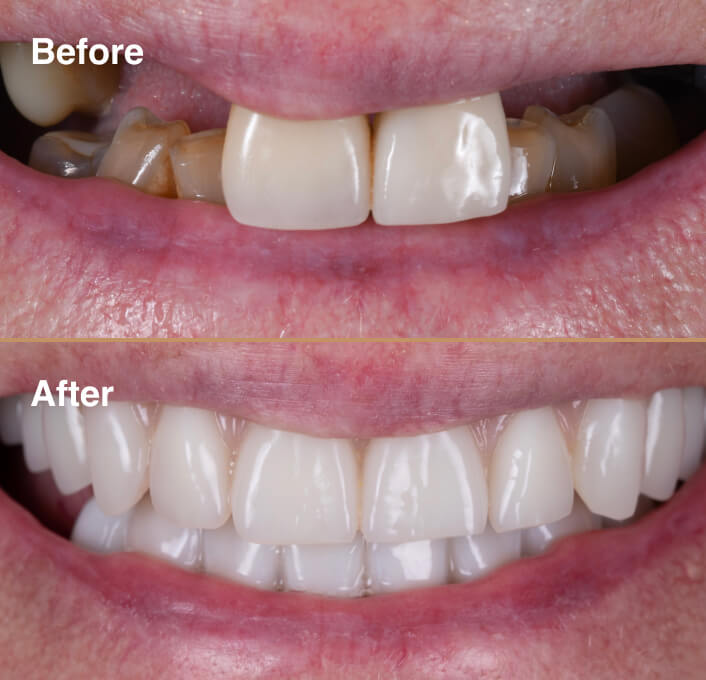 dental-implant-before-after-2