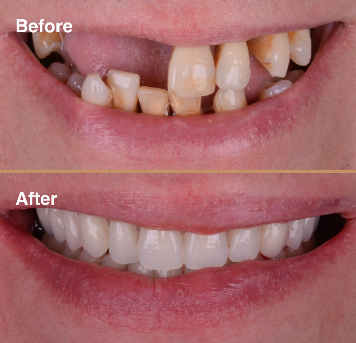 dental-implant-before-after-3