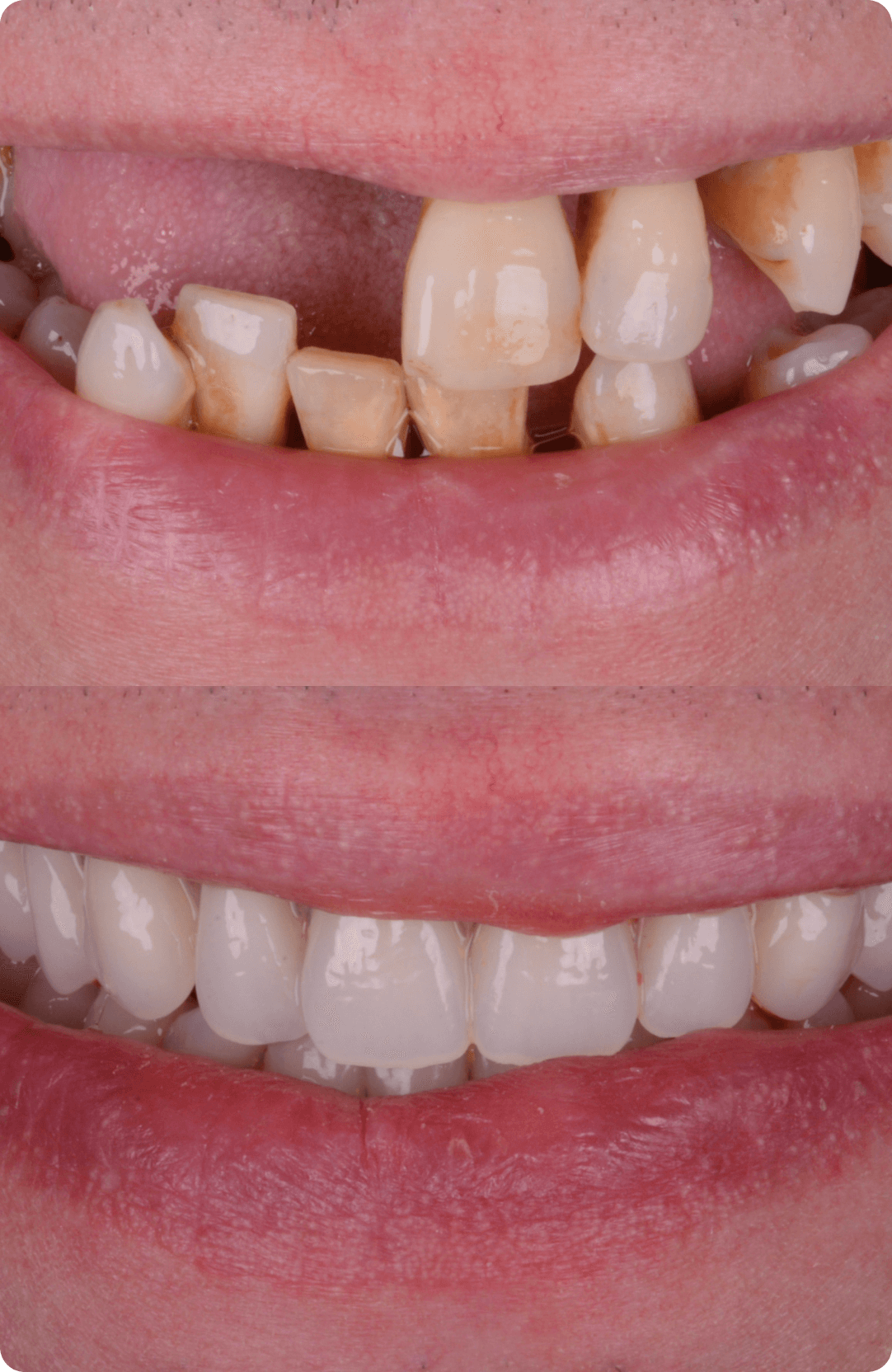 dental-implants-image-4