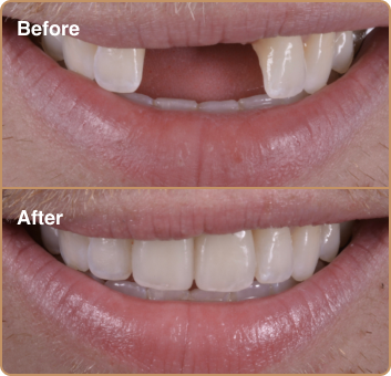 dental-treatment-before-after-img-1 Dental implants Manchester – replacing missing front teeth for a natural-looking smile
