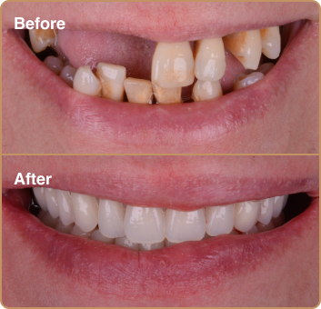 dental-treatment-before-after-img-3 Dental implants Manchester – same day smile makeover with immediate implants