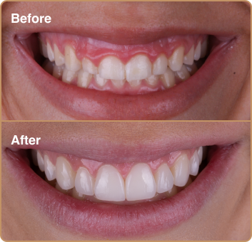 dental-treatment-before-after-img-5 Composite bonding Manchester – reshaping smile with gum contouring
