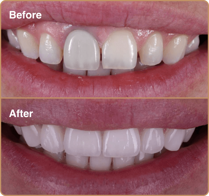 front-tooth-crown Porcelain veneers Manchester – replacing stained front crown for a natural look