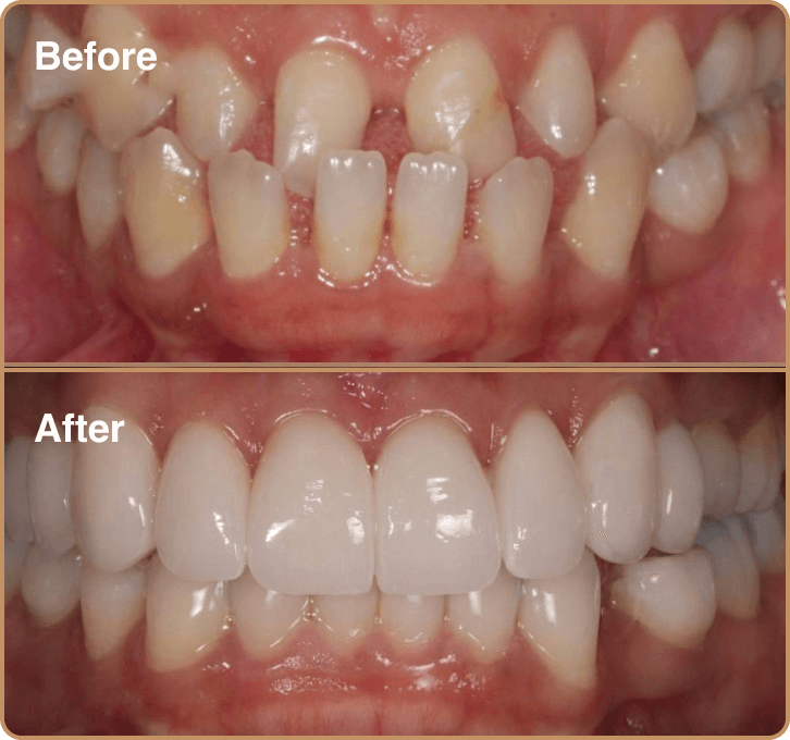 gappy-teeth Porcelain veneers London – improving smile with underbite correction