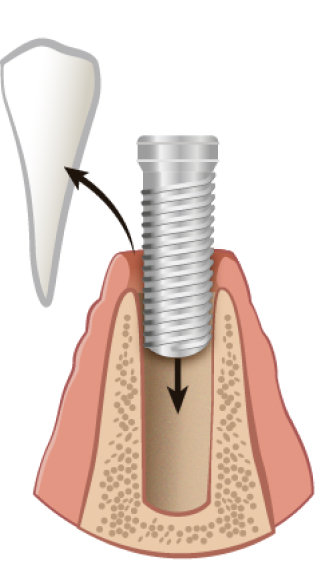 implant-process-1