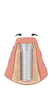 implant-process-2