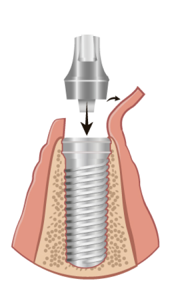 implant-process-3