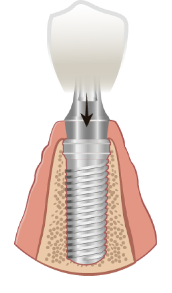 implant-process-4