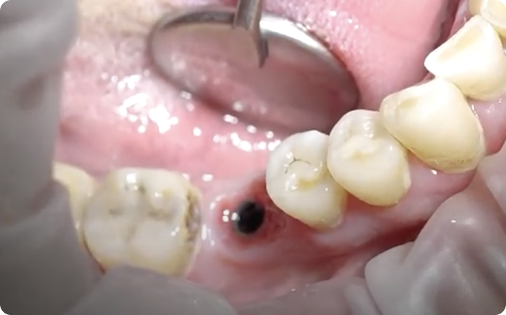 implant