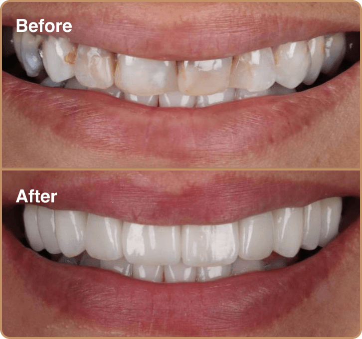 stained-teeth Porcelain veneers Manchester – transforming stained teeth into a brighter smile