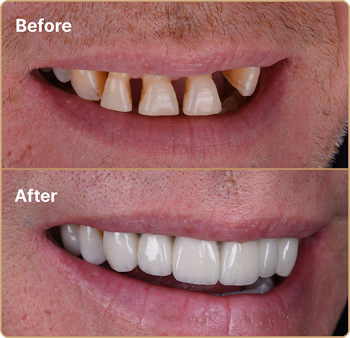 Porcelain Veneers for broken teeth Porcelain veneers Manchester – restoring broken teeth with a seamless finish