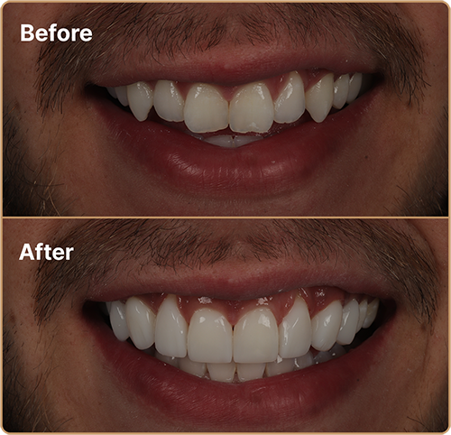 chipped front teeth Composite bonding Manchester – repairing chipped teeth for a smooth finish