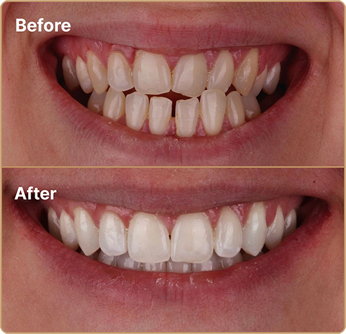 Invisalign before and after to fix crossbite Invisalign Manchester transformation – fixing crossbite with clear aligners