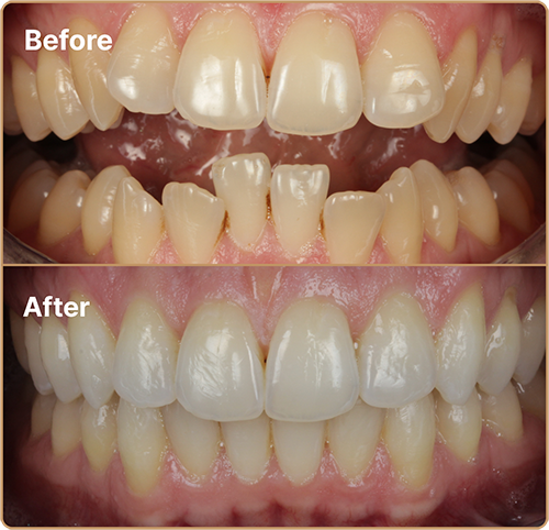 Invisalign before and after Invisalign London before and after – correcting crowded lower teeth