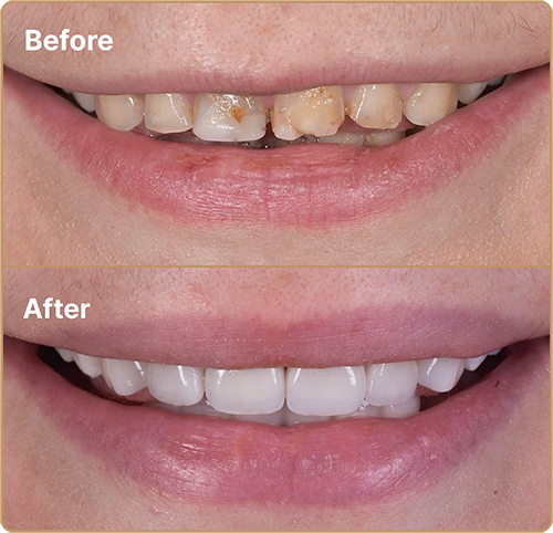 Porcelain Veneers before and after for discoloured teeth Porcelain veneers Manchester – covering stained teeth for a whiter, brighter smile