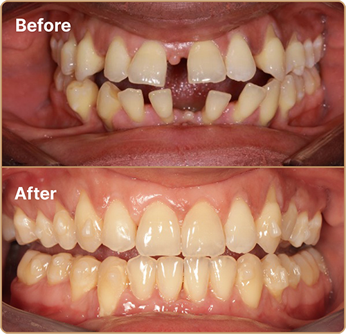Invisalign gappy teeth before and after Invisalign London results – closing gaps between teeth