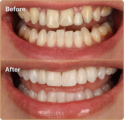 Composite bonding missing teeth Composite bonding London – restoring appearance of missing teeth