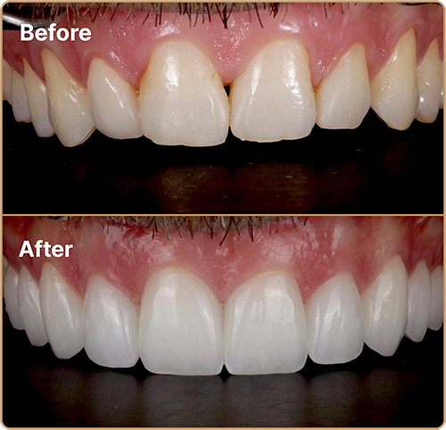 Porcelain veneers for small teeth before and after Porcelain veneers London – enhancing small teeth for a fuller, balanced smile