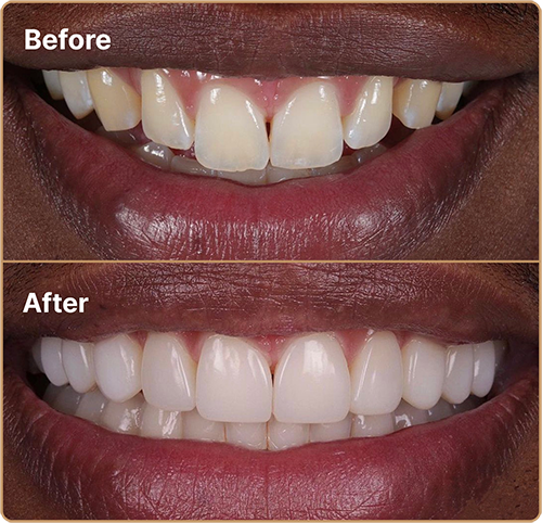 small teeth bonding before and after Composite bonding London – enhancing small teeth for a fuller smile