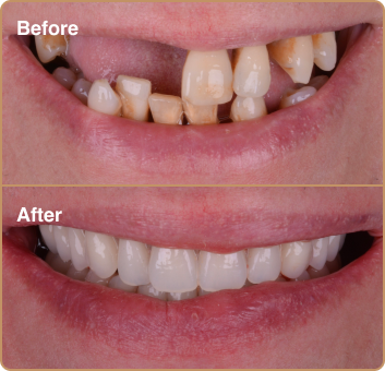dental_before_after_3 dental implant before and after