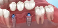 Bridgework-with-implants-1 Bridgework-with-implants-1