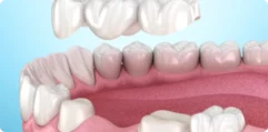 Dental-Bridges-1 Dental-Bridges-1