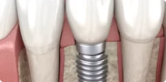 Dental-Implants-1 Dental-Implants-1