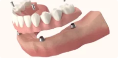 Implant-supported-dentures-1 Implant-supported-dentures-1