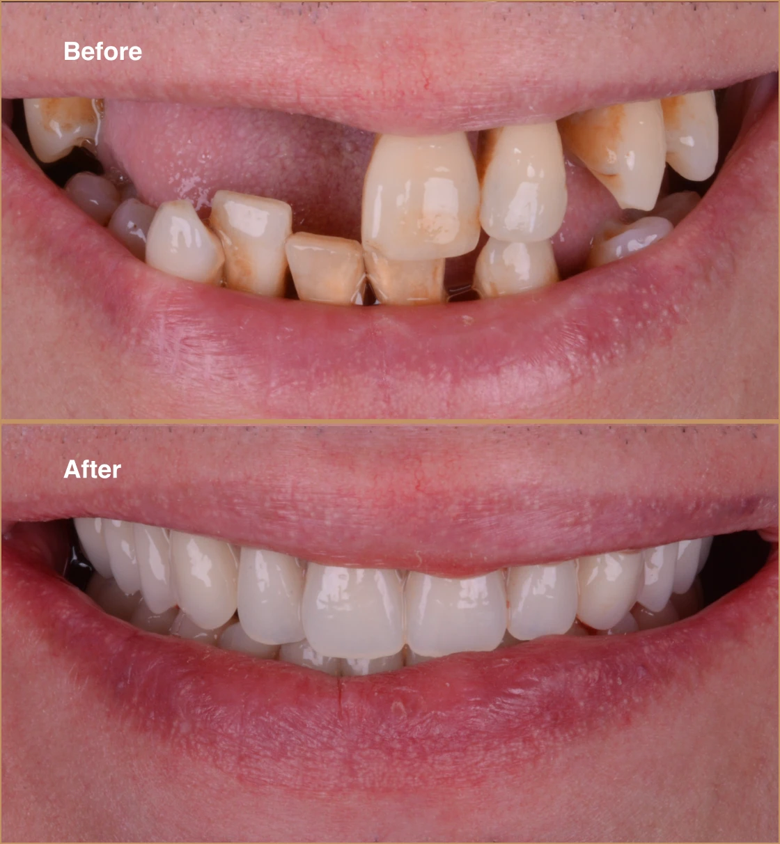 Missing-Teeth-1