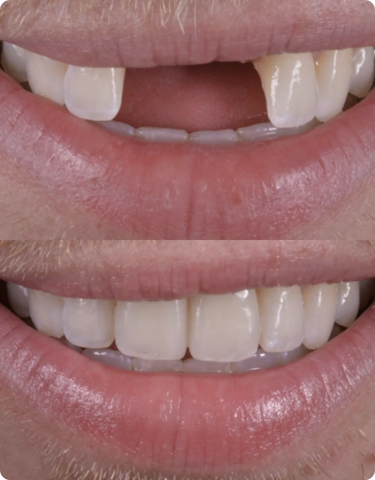 Multiple-Dental-Implants