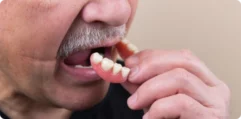 Partial-Dentures Partial-Dentures