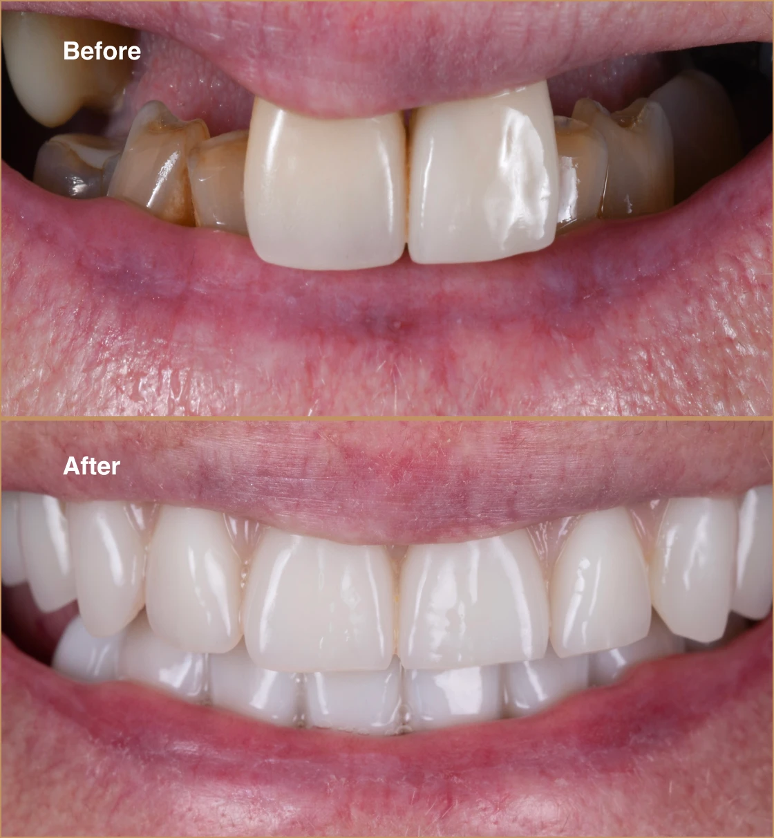 missing-teeth-2