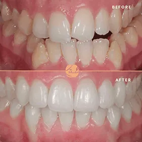 Beforeafter-one