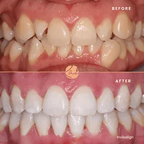 Beforeafter-two