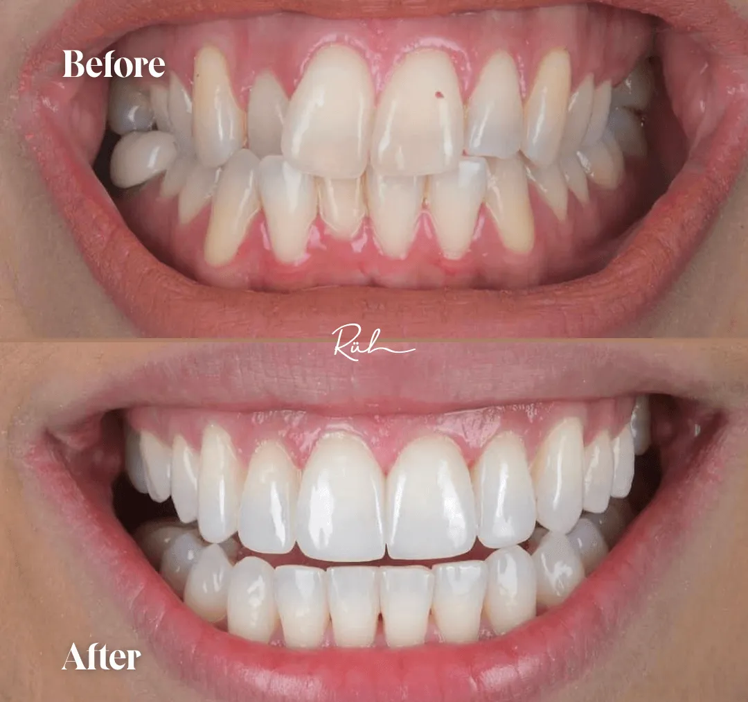 Whitening