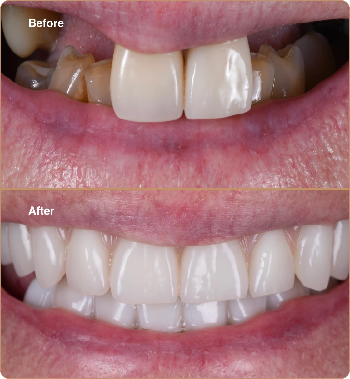 dentures-aesthetics